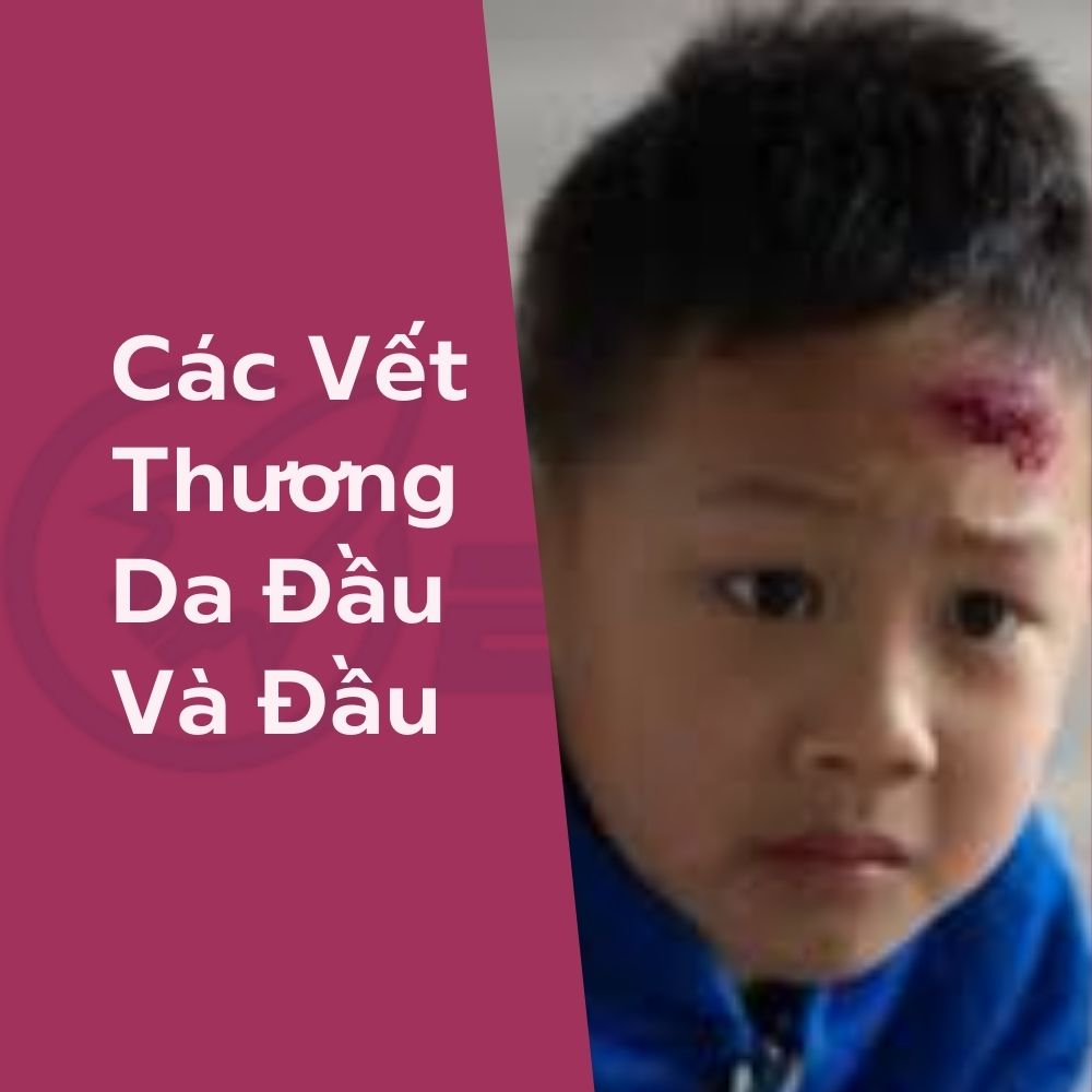 Các Điều Cần Biết Vết Thương Da Đầu Và Đầu